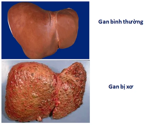 Bài thuốc hay trị xơ gan cổ trướng