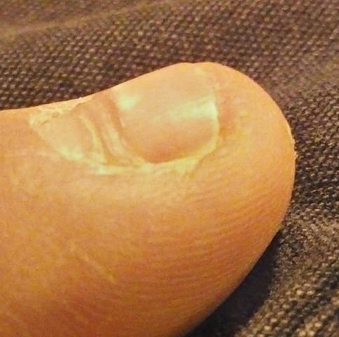 dấu hiệu bất thường ở móng tay dấu hiệu bất thường ở móng tay