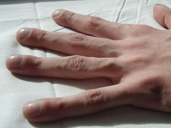 8 dấu hiệu này ở móng tay bạn tuyệt đối không được chủ quan