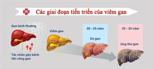 Cách phòng tránh ung thư gan 