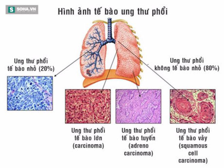 5 bệnh ung thư nguy hiểm nhất bất kỳ ai cũng có thể mắc phải - Ảnh 4 5 benh ung thu nguy hiem nhat bat ky ai cung co the mac phai - Anh 4