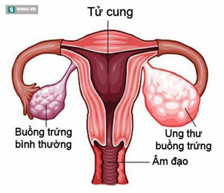 5 bệnh ung thư nguy hiểm nhất bất kỳ ai cũng có thể mắc phải - Ảnh 5 5 benh ung thu nguy hiem nhat bat ky ai cung co the mac phai - Anh 5