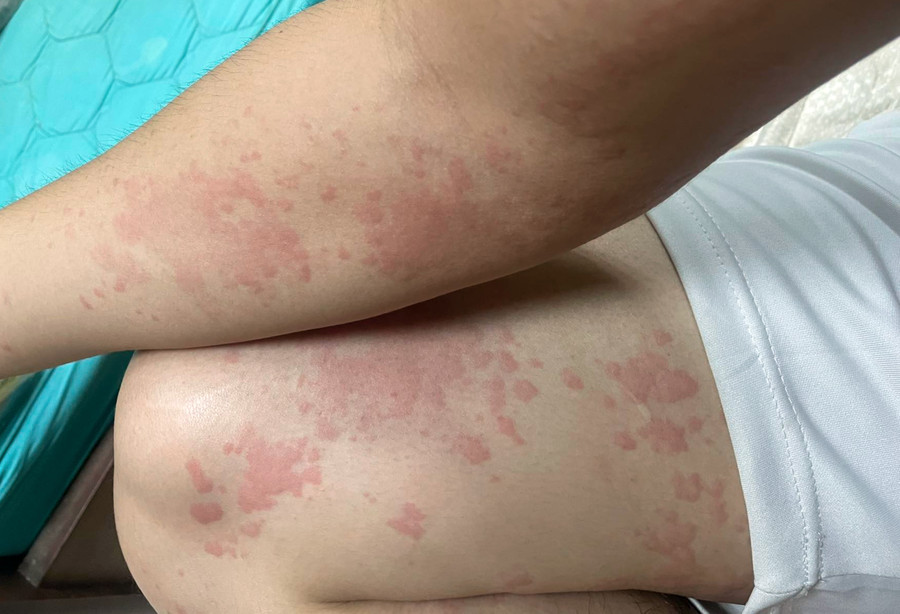 Bệnh nhân nổi mề đay, phát ban toàn thân do thời tiết nắng nóng. Ảnh: BVCC Bệnh nhân nổi mề đay, phát ban toàn thân do thời tiết nắng nóng. Ảnh: BVCC