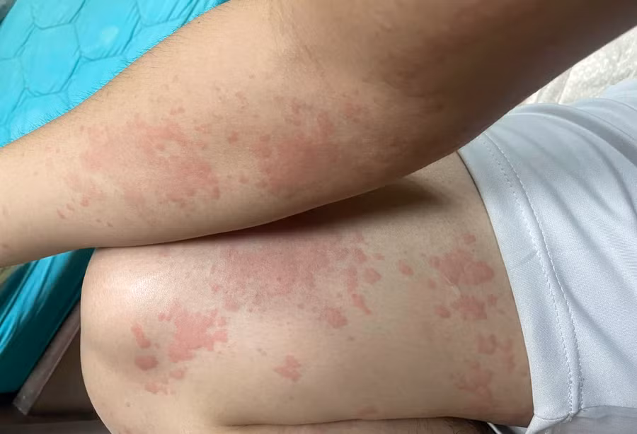 Bệnh nhân nổi mề đay, phát ban toàn thân do thời tiết nắng nóng. Ảnh: BVCC Bệnh nhân nổi mề đay, phát ban toàn thân do thời tiết nắng nóng. Ảnh: BVCC