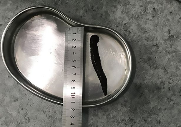 Con đỉa sau khi được bác sĩ gắp ra. Con đỉa sau khi được bác sĩ gắp ra.