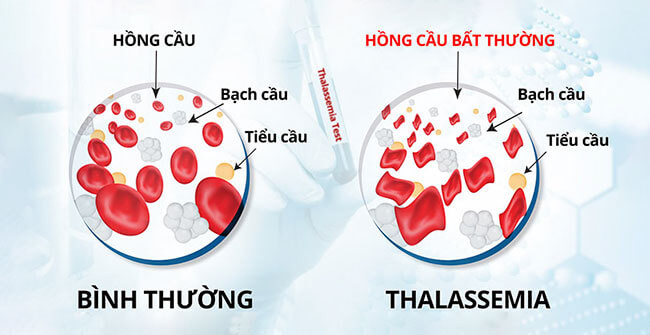 Bệnh nhân Thalassemia, do hồng cầu vỡ sớm hơn bình thường dẫn đến tình trạng thiếu máu. Bệnh nhân Thalassemia, do hồng cầu vỡ sớm hơn bình thường dẫn đến tình trạng thiếu máu.