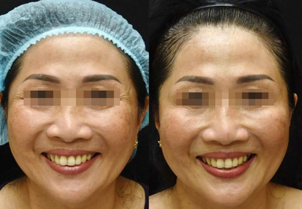 Trước và sau khi điều trị xóa nhăn đuôi mắt bằng botulinum toxin. Ảnh: Bệnh viện Da liễu TPHCM