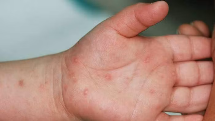 Biểu hiện bệnh tay chân miệng ở trẻ (Ảnh: Báo Chính phủ).