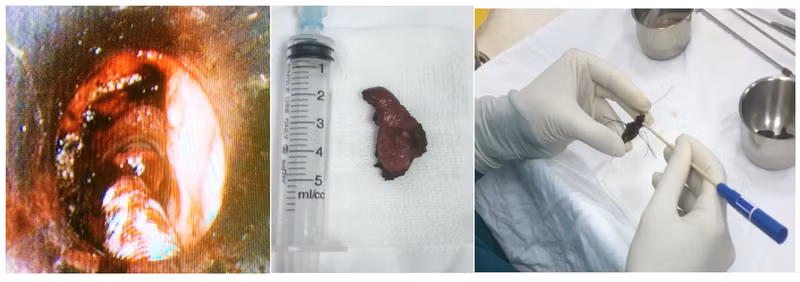 Ứng dụng phẫu thuật laser vi phẫu qua đường miệng trong điều trị ung thư thanh quản tầng thanh môn giai đoạn sớm tại Bệnh viện Tai Mũi Họng TPHCM.