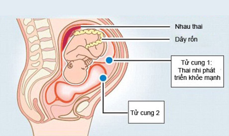 Cô gái có 2 âm đạo tiết lộ rắc rối trong chuyện mang bầu, sinh con - Ảnh 3 Co gai co 2 am dao tiet lo rac roi trong chuyen mang bau, sinh con - Anh 3