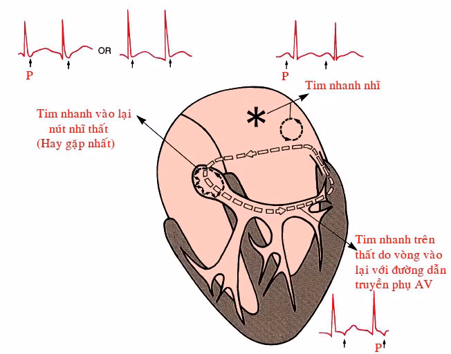 Khuyến cáo Hội chứng tim sau kỳ nghỉ lễ
