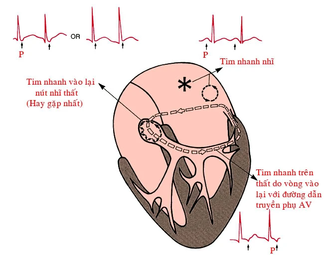 Khuyến cáo Hội chứng tim sau kỳ nghỉ lễ