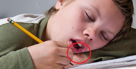 Chảy nước dãi khi ngủ cảnh báo một số bệnh - Ảnh 1 Chay nuoc dai khi ngu canh bao mot so benh - Anh 1