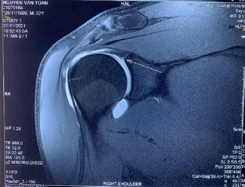 Phim MRI khi có tiêm thuốc thấy rõ tổn thương hơn.