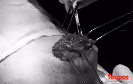 Bien chung dang so khi tiem silicon nang nguc, chat lam day vao co - Anh 2