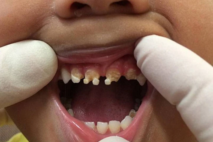 Tác hại khôn lường từ sở thích uống nước ngọt có ga