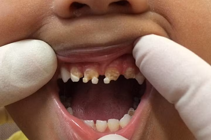 Tác hại khôn lường từ sở thích uống nước ngọt có ga