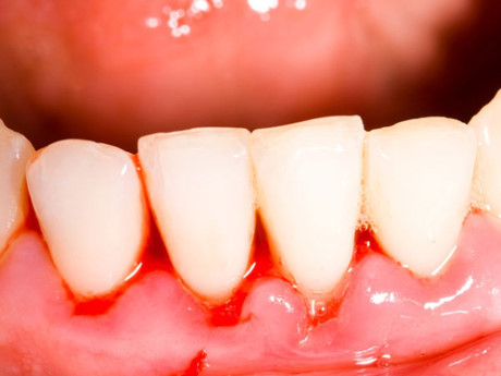 Bạn có biết cách dùng dầu dừa giải độc tố cho miệng? - Ảnh 2 Ban co biet cach dung dau dua giai doc to cho mieng? - Anh 2