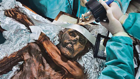 Người băng Otzi và những phát hiện mới có ích cho y học - Ảnh 5 Nguoi bang Otzi va nhung phat hien moi co ich cho y hoc - Anh 5