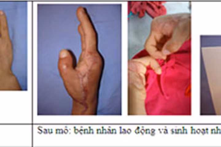 Cuộc sống trở lại với cô gái sau ca mổ ghép ngón chân thành ngón tay cái