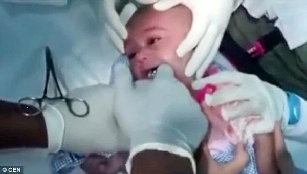 Nghẹt thở cảnh giải cứu bé trai 1 tuổi nuốt phải đồng hồ đeo tay