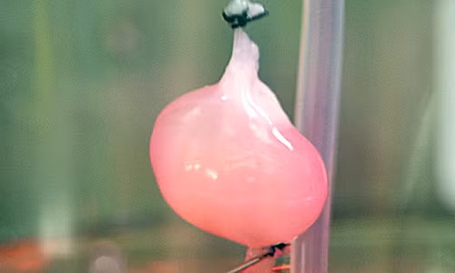 Thận nhân tạo: Niềm hi vọng của bệnh nhân suy thận - 2