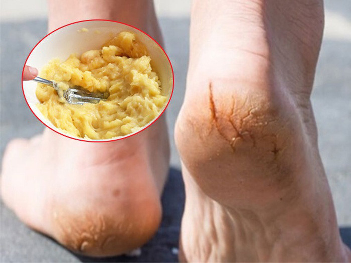 Bỏ túi cách trị nứt nẻ gót chân tại nhà cực kỳ hiệu quả
