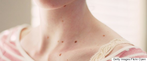 6 bộ phận cơ thể thường bị bỏ quên chống nắng