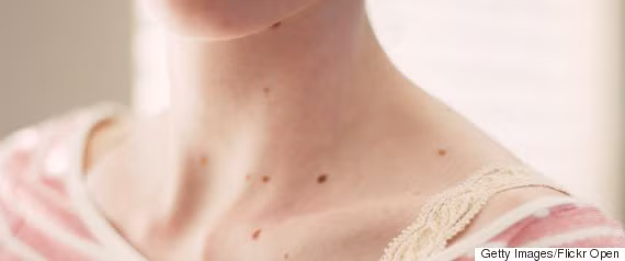 6 bộ phận cơ thể thường bị bỏ quên chống nắng