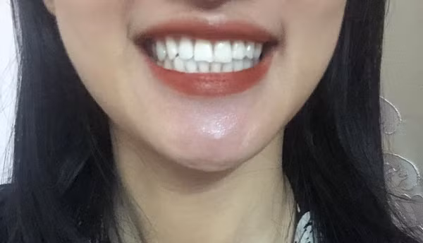 Hàm răng đều tăm tắp và trắng sáng giúp Phương Thảo tự tin hơn trong cuộc sống.