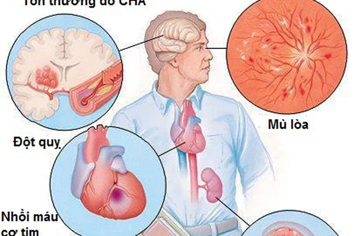 Tránh tác dụng phụ của thuốc chữa tăng huyết áp