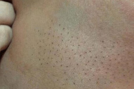 Kinh hãi với hình ảnh cô bé 5 tháng tuổi bị mọc gai đen khắp người - Ảnh 1 Kinh hai voi hinh anh co be 5 thang tuoi bi moc gai den khap nguoi - Anh 1