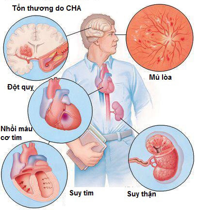 Tránh tác dụng phụ của thuốc chữa tăng huyết áp - Ảnh 1 Tranh tac dung phu cua thuoc chua tang huyet ap - Anh 1