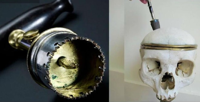 1. Dụng cụ khoan sọ. Dụng cụ khoan bằng tay này được sử dụng để khoan vào vùng sọ. Mũi nhọn ở giữa chiếc khoan được chế tạo cho việc cắt và sau đó các mũi khoan xung quanh sẽ tiến hành khoan. Đây là một trong những dụng cụ y tế đáng sợ được The Richest thống kê. Những dụng cụ y tế đáng sợ nhất trong lịch sử