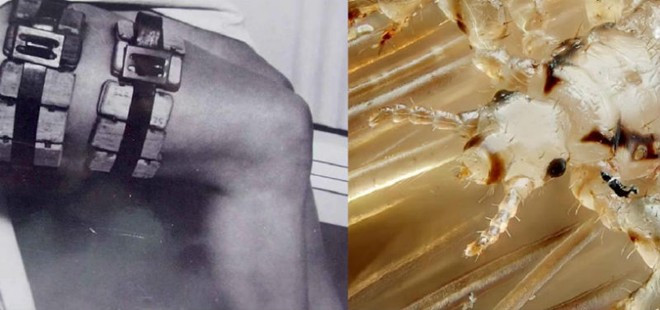 7. Lồng nuôi rận. Để tạo ra phương pháp chữa các căn bệnh chết người do vi khuẩn gây ra, con rận đã được lai tạo và nuôi dưỡng bằng máu của người ốm bên trong một cái lồng gắn vào hai chân của bệnh nhân. Con rận bị nhiễm bệnh sẽ bị mổ xẻ để tiêm vắc-xin. Những dụng cụ y tế đáng sợ nhất trong lịch sử