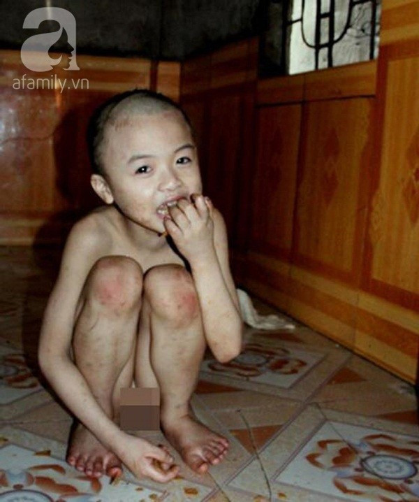 Cuộc sống như “tù ngục” của bé mồ côi mắc u não Cuộc sống như “tù ngục” của bé mồ côi mắc u não