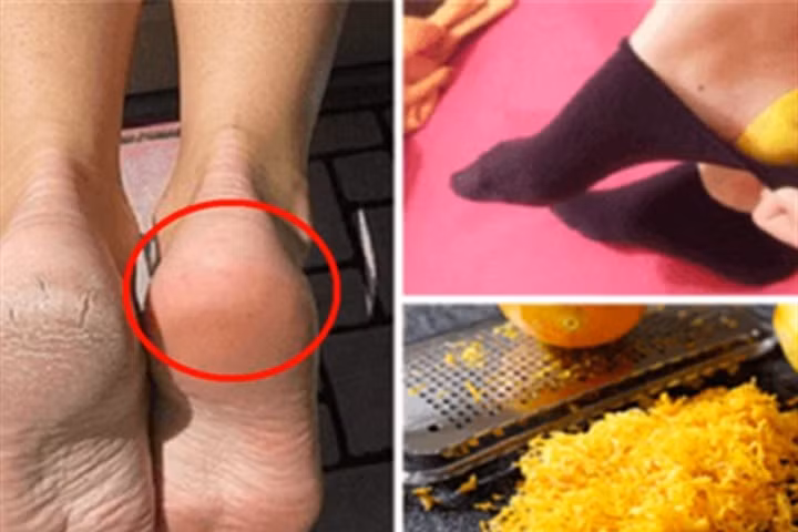 Hô biến gót chân nứt nẻ thành láng mịn trong giây lát chỉ với vỏ chanh