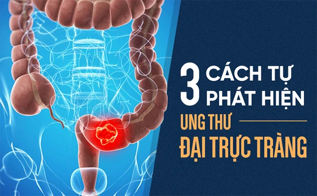 Cách tự kiểm tra ung thư đại trực tràng: Phát hiện sớm 3 tháng, có thể sống thêm 30 năm