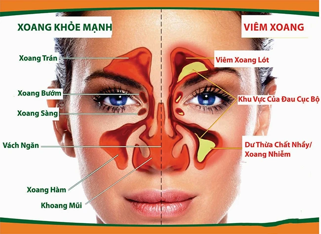 Chữa viêm xoang, viêm mũi dị ứng lâu năm, có thể trị dứt bằng thảo dược này