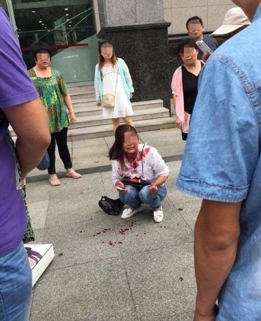 Phẫn nộ chàng trai cắn đứt tai bạn gái vì mâu thuẫn - Ảnh 1 Phẫn nộ chàng trai cắn đứt tai bạn gái vì mâu thuẫn - Ảnh 1