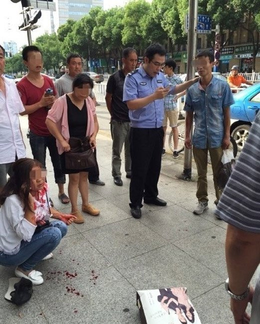 Phẫn nộ chàng trai cắn đứt tai bạn gái vì mâu thuẫn - Ảnh 3 Phẫn nộ chàng trai cắn đứt tai bạn gái vì mâu thuẫn - Ảnh 3