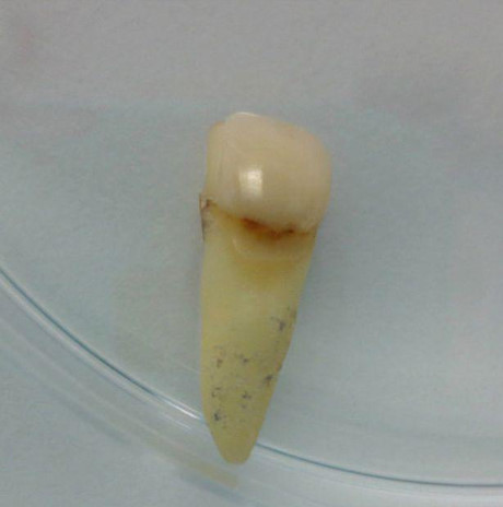 Chuyện hy hữu trong thế giới trộm cắp: Bị bắt sau nhiều tháng vì chiếc răng gãy - Ảnh 1 Chuyen hy huu trong the gioi trom cap: Bi bat sau nhieu thang vi chiec rang gay - Anh 1