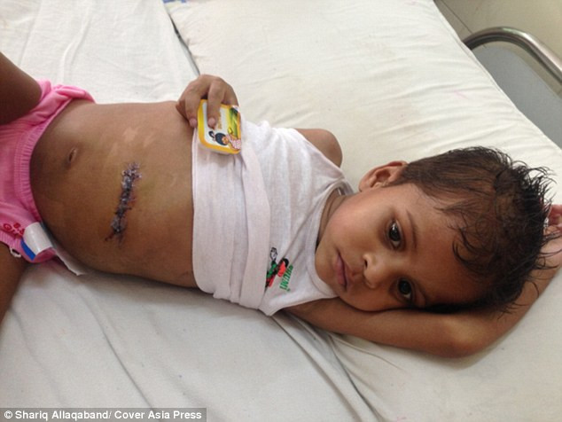 hội chứng, phẫu thuật, x-quang, Ấn Độ, tóc, ăn, tiến sĩ, bệnh viện, khoa nhi, chẩn đoán