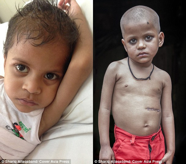 hội chứng, phẫu thuật, x-quang, Ấn Độ, tóc, ăn, tiến sĩ, bệnh viện, khoa nhi, chẩn đoán