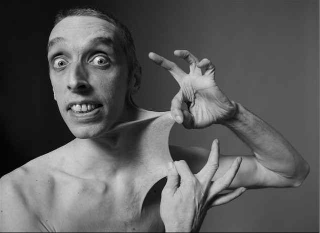 Gary Turner là một nghệ sĩ trình diễn. Anh hiện đang giữ kỷ lục Guiness về khả năng kéo da giãn dài nhất thế giới. Khả năng này thực tế là hội chứng của căn bệnh hiếm có tên Ehlers Danlos. Anh có thể kéo phần da trên bụng của mình ra đến 15cm.