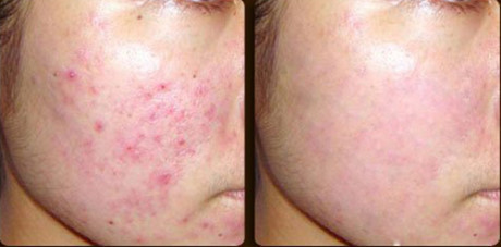 Tự làm toner trà xanh giải quyết nỗi lo cho các nàng da mụn - Ảnh 7 Tu lam toner tra xanh giai quyet noi lo cho cac nang da mun - Anh 7
