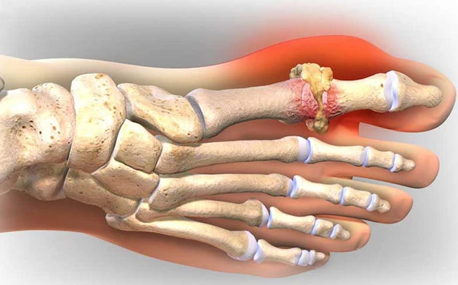 Lời khuyên bác sĩ: Chữa khỏi bệnh gout không phải thuốc, mà do bí quyết “ĂN ít, ỘP nhiều”