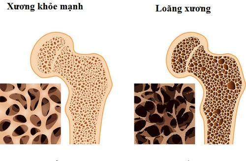 Tái tạo xương từ tế bào gốc