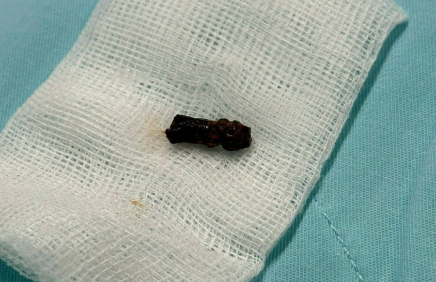 Dị vật nằm ở vị trí khó tiếp cận nên phải dùng hệ thống nội soi phế quản bằng ống soi mềm để lấy dị vật ra khỏi đường thở của bé.