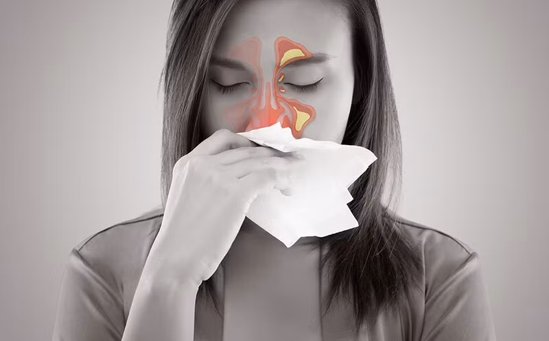 Viêm xoang cấp tính gây đau nhức mũi, nặng mặt